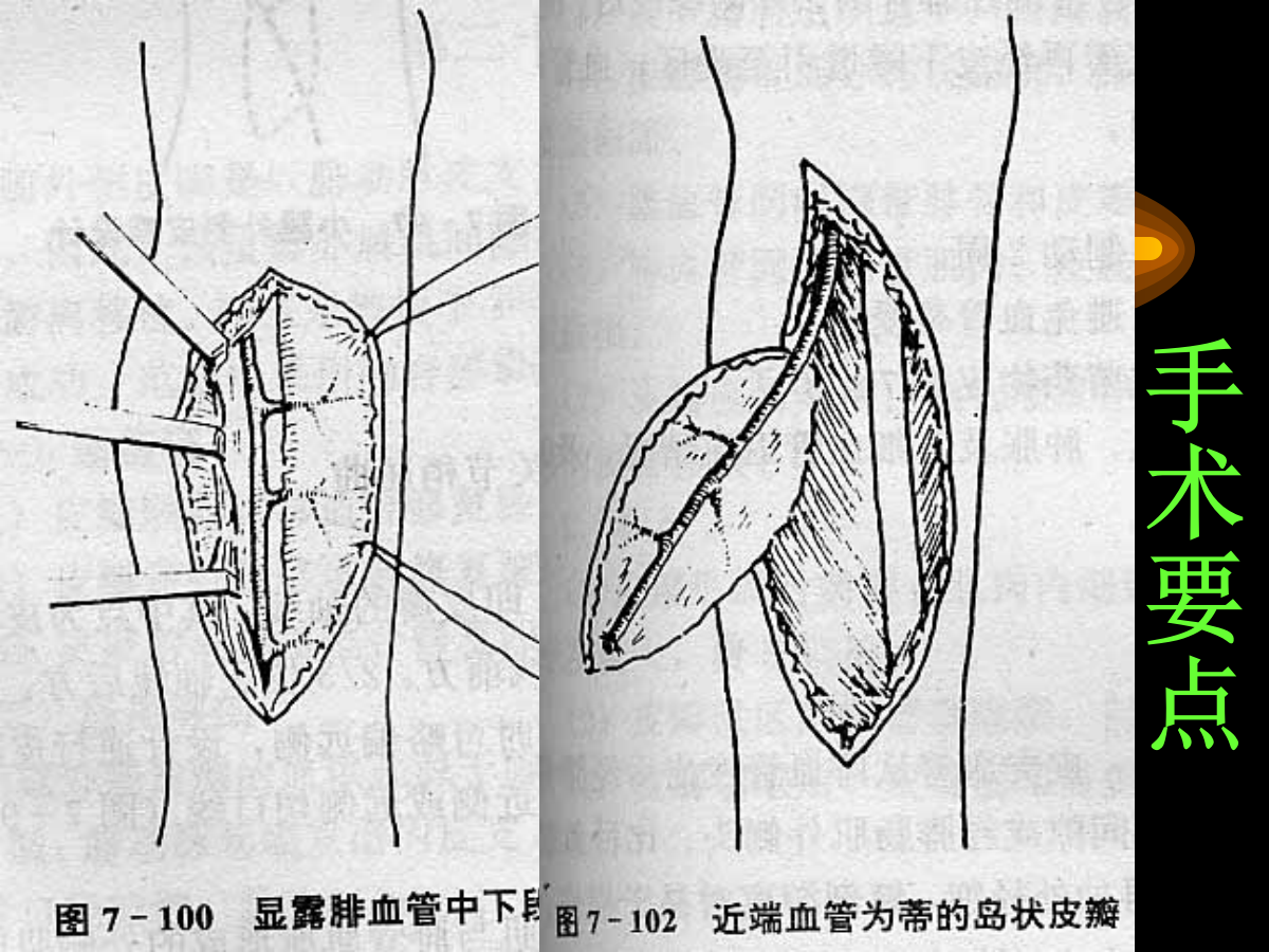 系统详解：骨科常用游离肌皮瓣及皮瓣！