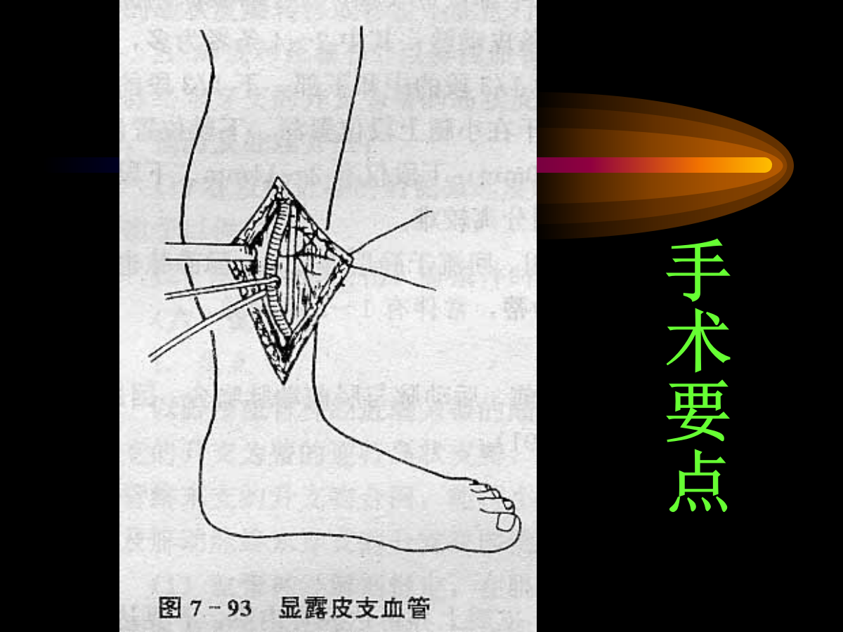 系统详解：骨科常用游离肌皮瓣及皮瓣！