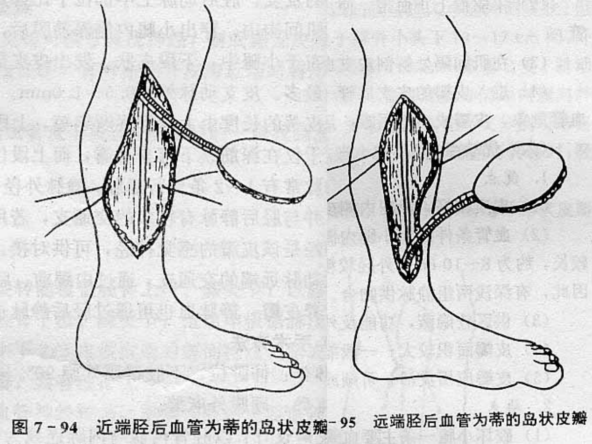 系统详解：骨科常用游离肌皮瓣及皮瓣！