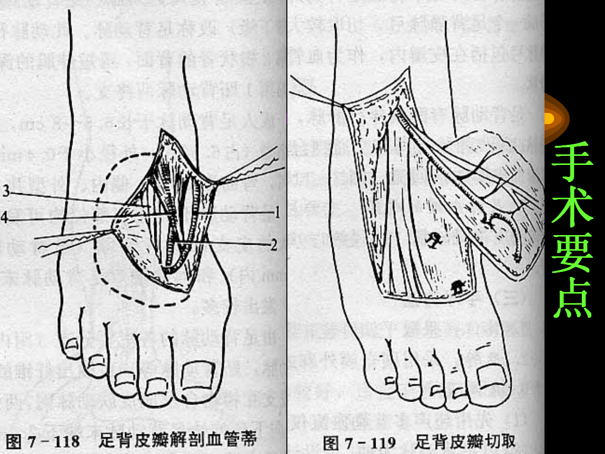 系统详解：骨科常用游离肌皮瓣及皮瓣！