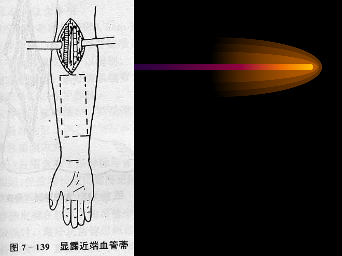 系统详解：骨科常用游离肌皮瓣及皮瓣！