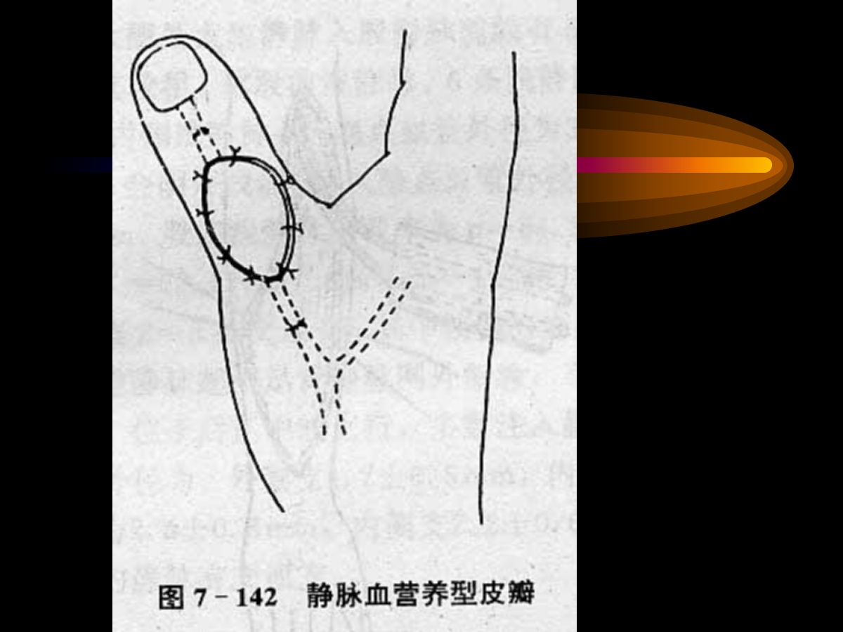 系统详解：骨科常用游离肌皮瓣及皮瓣！