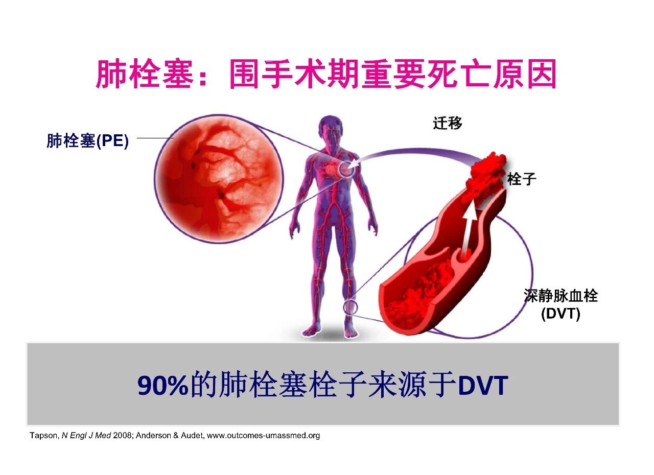当抗凝遇上出血，如何预防DVT？