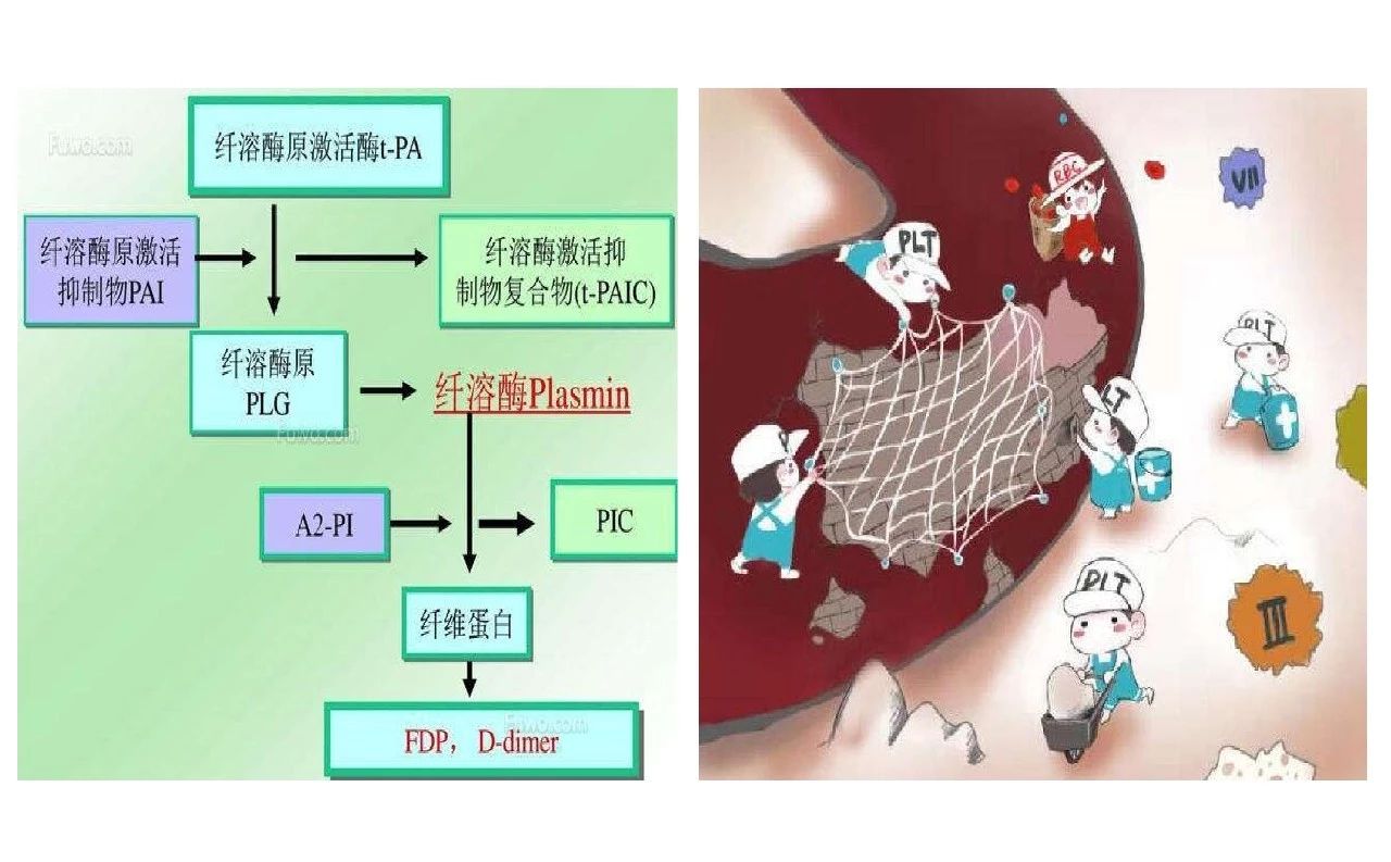 当抗凝遇上出血，如何预防DVT？