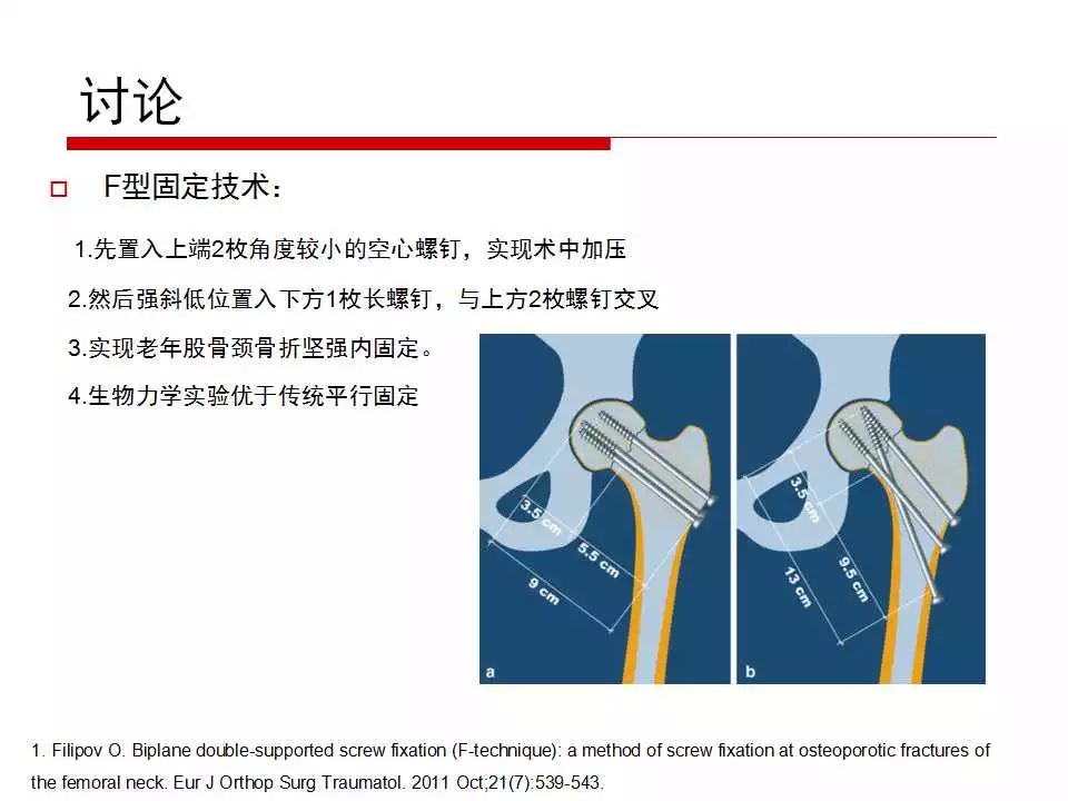 老年股骨颈骨折的F型空心钉固定技术介绍