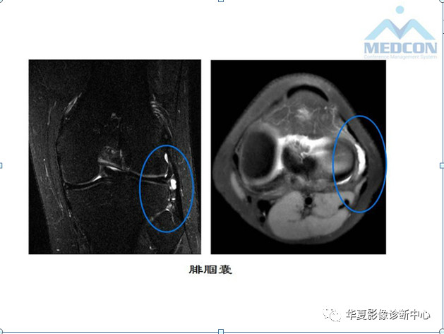 5大关节旁滑囊的精细解剖及滑囊病变的影像诊断