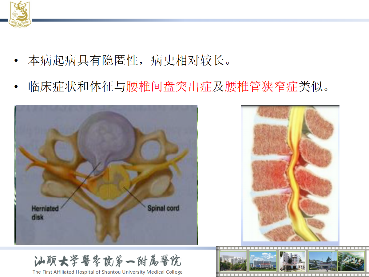 椎间孔镜技术在椎体后缘骺环离断中的应用