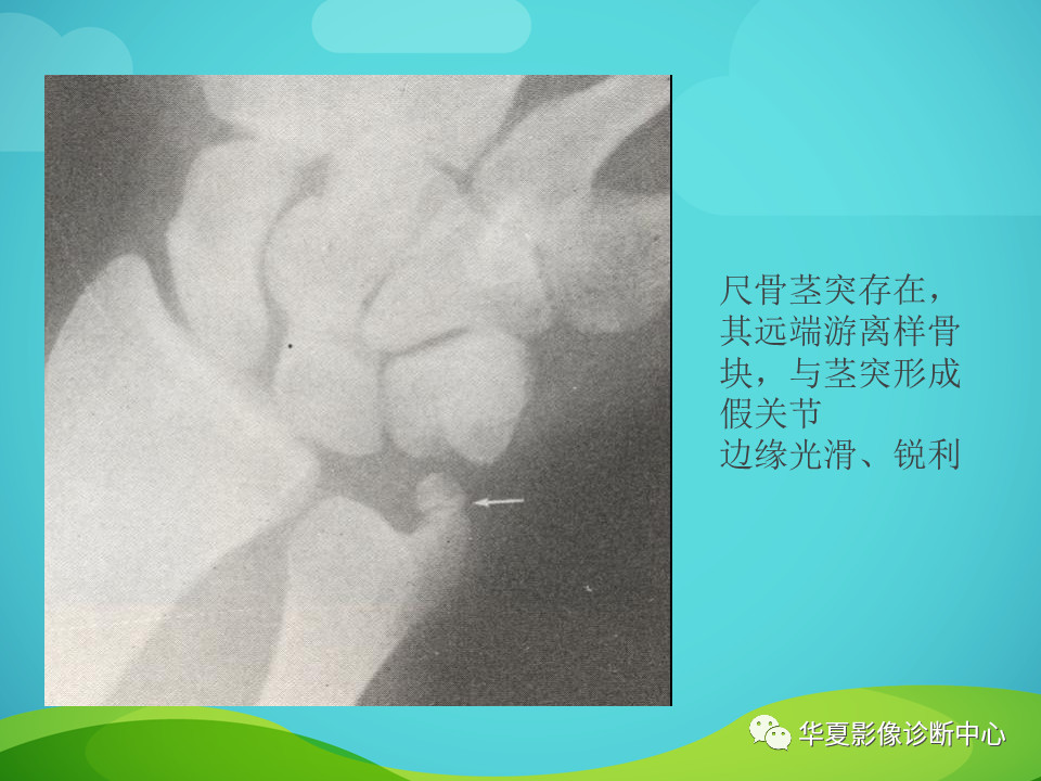 骨关节正常变异汇总，值得收藏！