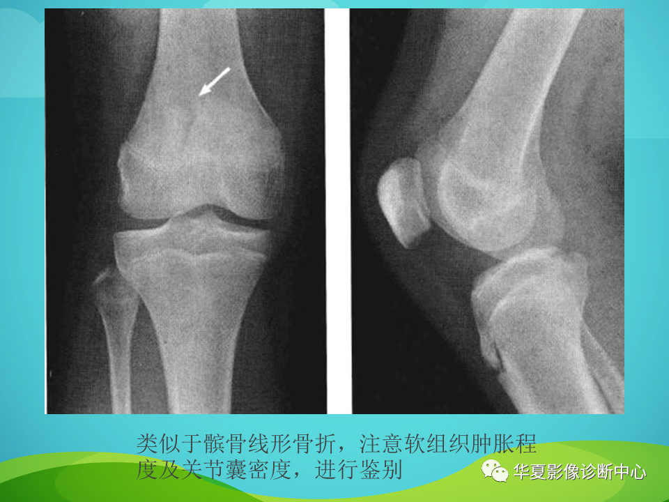 骨关节正常变异汇总，值得收藏！