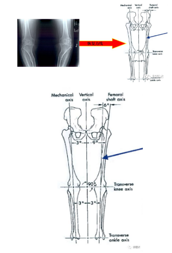 干货满满：全膝关节置换的截骨原则与技巧详解！