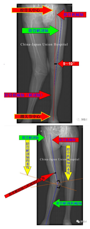 干货满满：全膝关节置换的截骨原则与技巧详解！