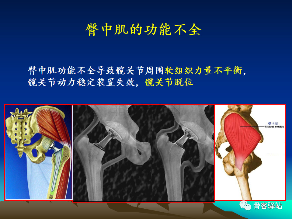 仿生双动髋关节在臀中肌功能不全中的应用