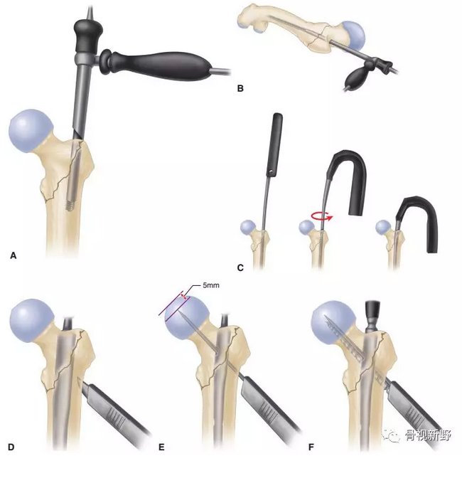 图解：粗隆间骨折的基本手术技术