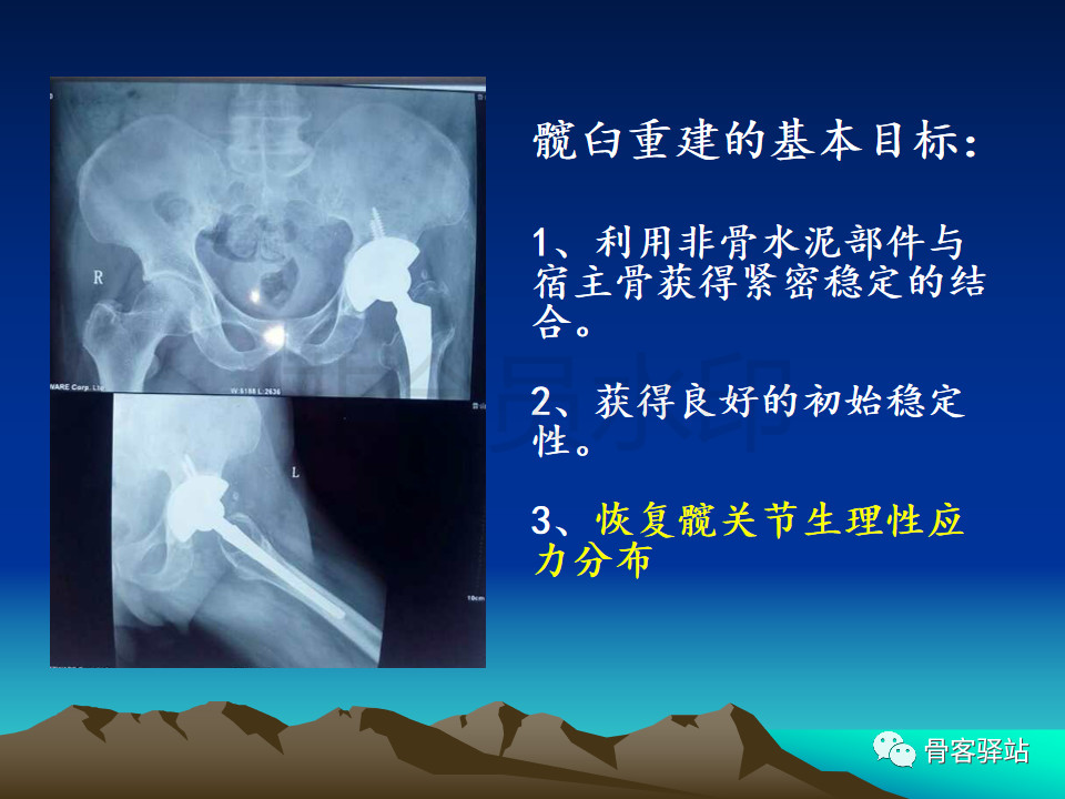 人工髋关节翻修髋臼侧重建旋转中心难点解析