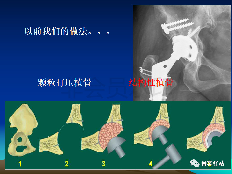 髋臼旋转中心图片