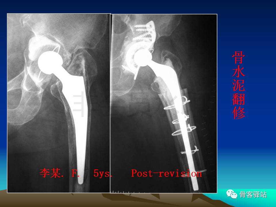 人工髋关节翻修髋臼侧重建旋转中心难点解析