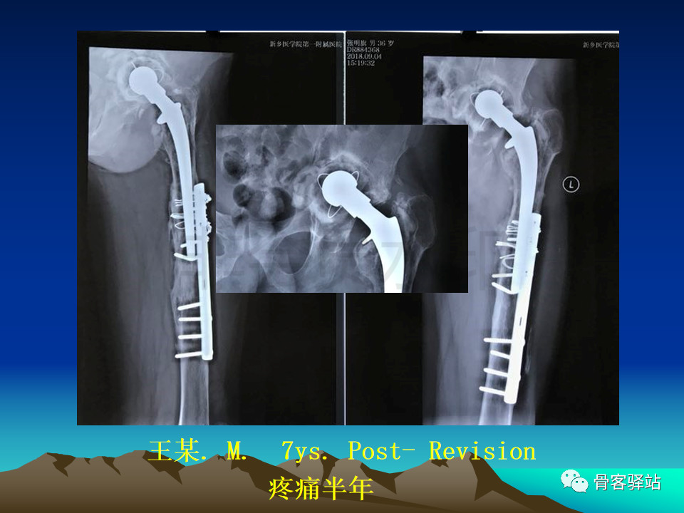 人工髋关节翻修髋臼侧重建旋转中心难点解析