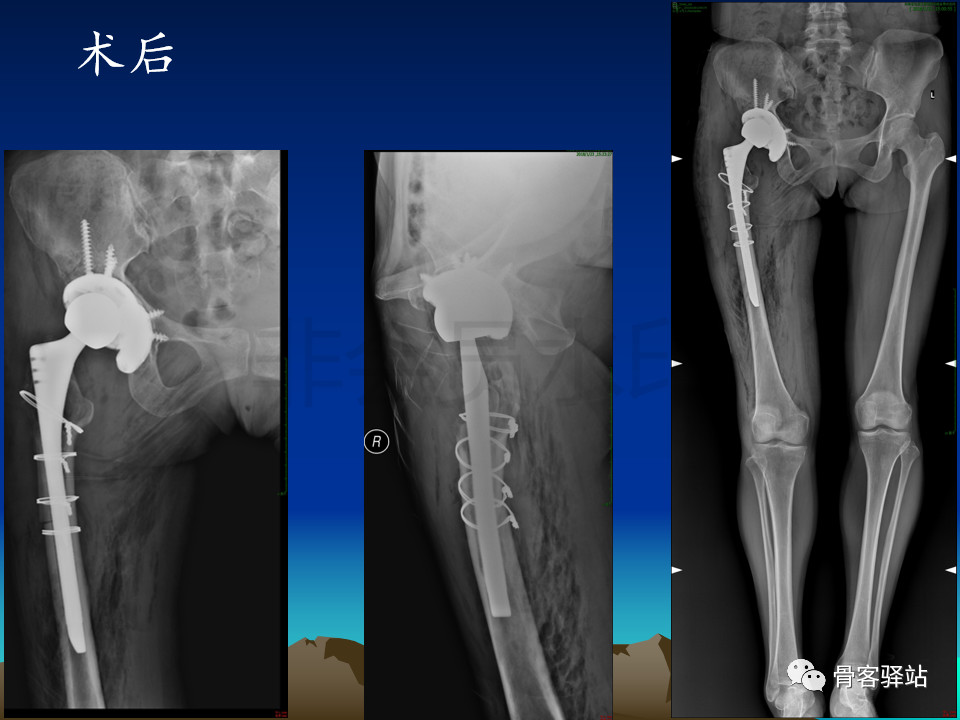 人工髋关节翻修髋臼侧重建旋转中心难点解析