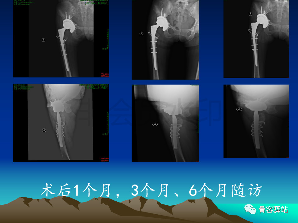 人工髋关节翻修髋臼侧重建旋转中心难点解析