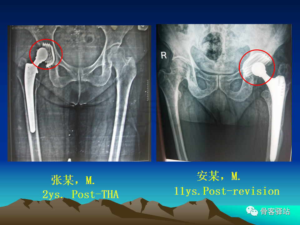 人工髋关节翻修髋臼侧重建旋转中心难点解析