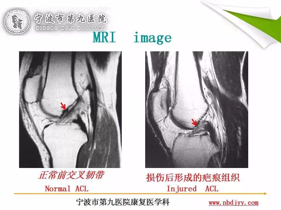 一篇掌握：前交叉韧带重建及术后康复