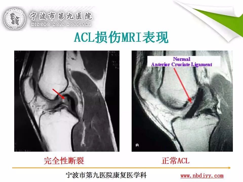 一篇掌握：前交叉韧带重建及术后康复