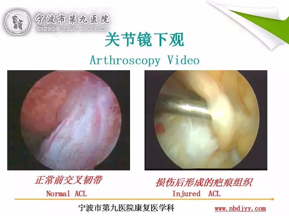 一篇掌握：前交叉韧带重建及术后康复