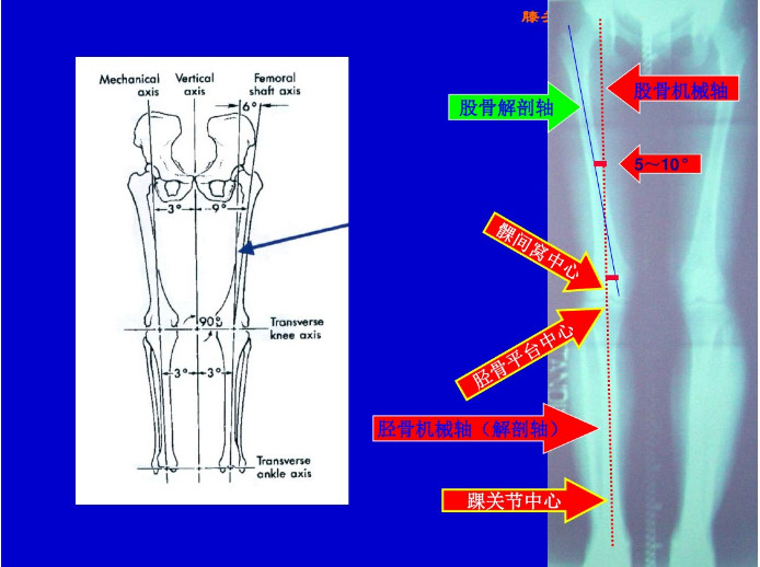 膝关节置换截骨平面的选择，看这篇！