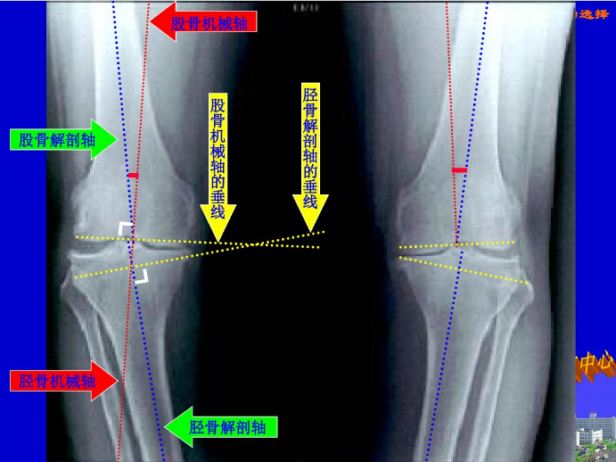 膝关节置换截骨平面的选择，看这篇！