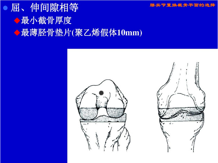 膝关节置换截骨平面的选择，看这篇！