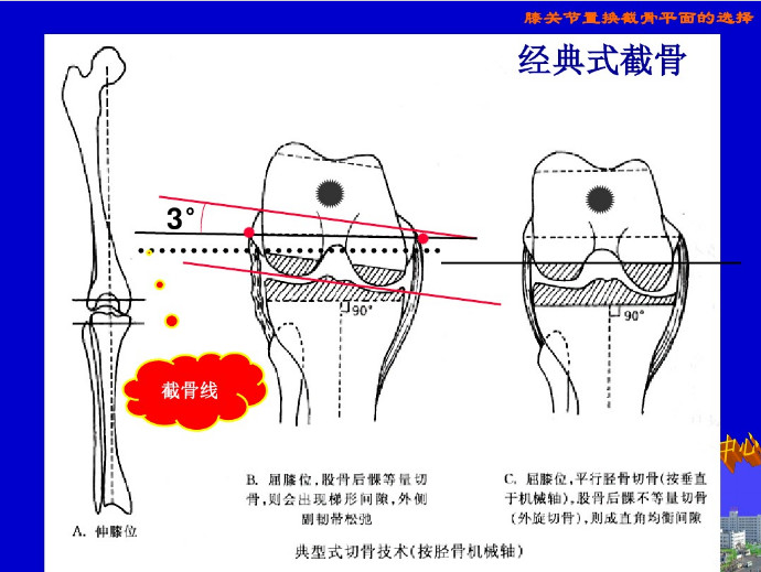 膝关节置换截骨平面的选择，看这篇！
