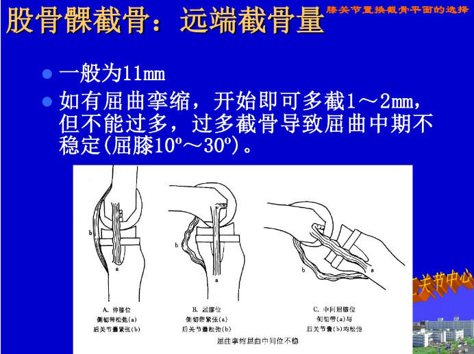 膝关节置换截骨平面的选择，看这篇！