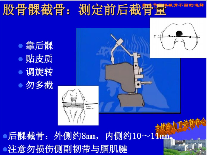 膝关节置换截骨平面的选择，看这篇！