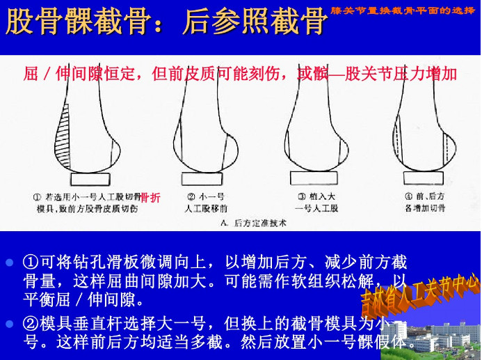 膝关节置换截骨平面的选择，看这篇！