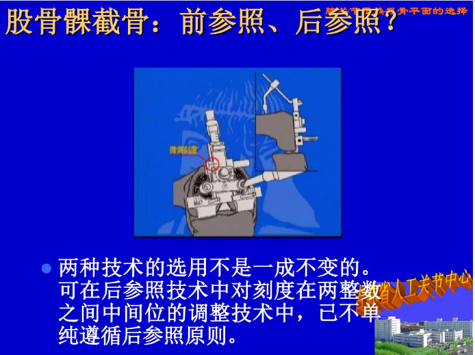 膝关节置换截骨平面的选择，看这篇！