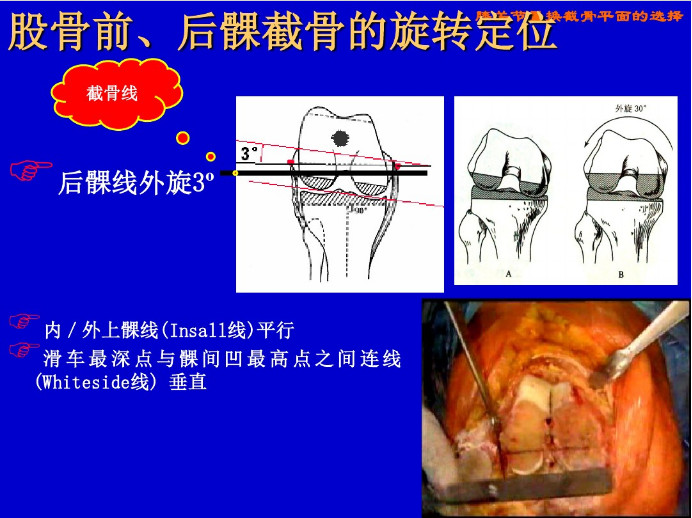 膝关节置换截骨平面的选择，看这篇！