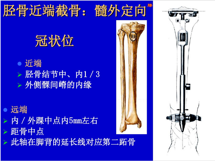 膝关节置换截骨平面的选择，看这篇！