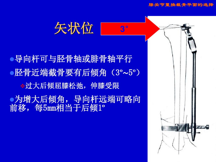 膝关节置换截骨平面的选择，看这篇！