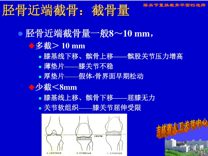 膝关节置换截骨平面的选择，看这篇！