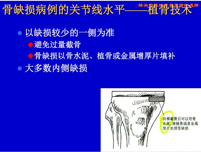 膝关节置换截骨平面的选择，看这篇！