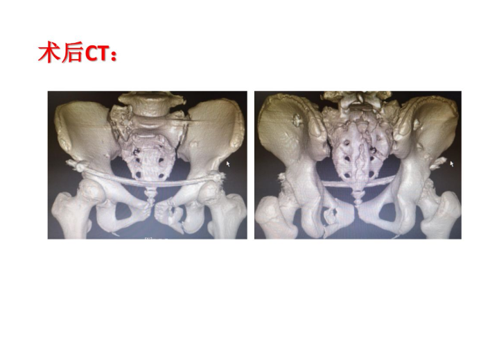 病例分享：骨盆C2型骨折合并腰骶干损伤