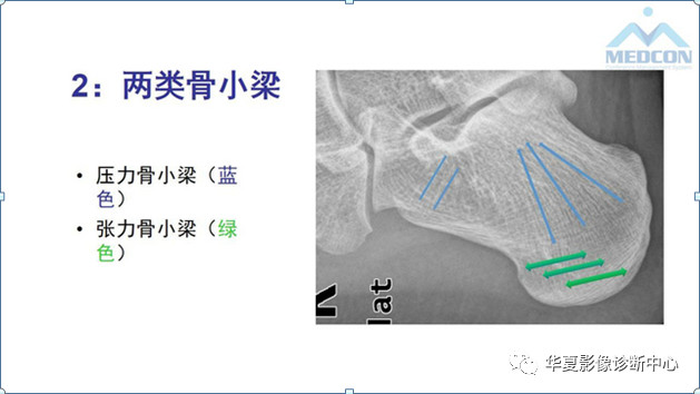 跟骨病变都在这里，赶快收藏吧！