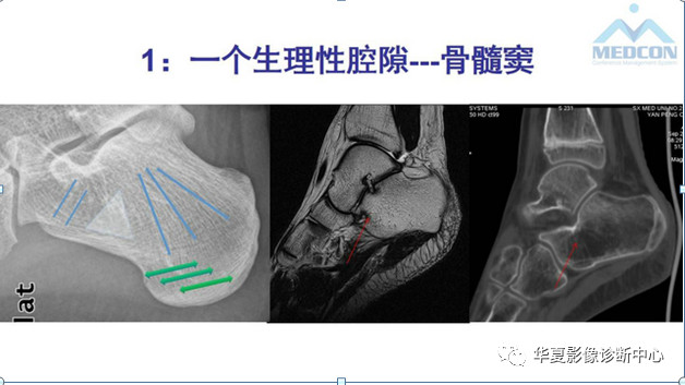 跟骨病变都在这里，赶快收藏吧！