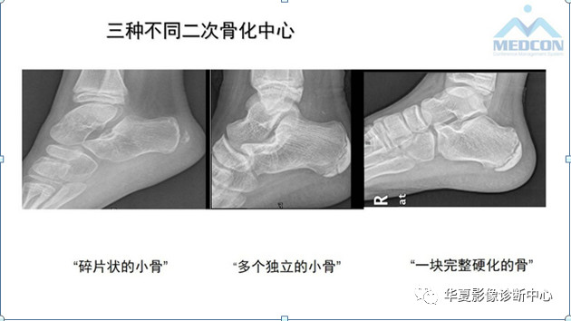 跟骨病变都在这里，赶快收藏吧！