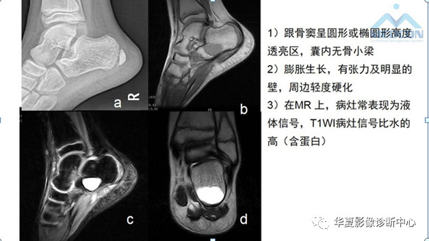 跟骨病变都在这里，赶快收藏吧！