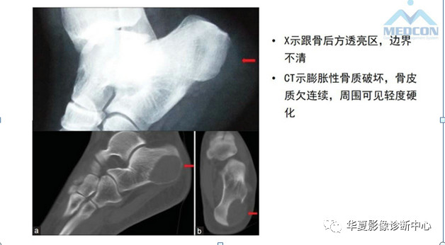 跟骨病变都在这里，赶快收藏吧！