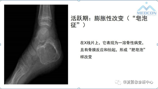 跟骨病变都在这里，赶快收藏吧！