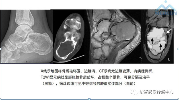 跟骨病变都在这里，赶快收藏吧！