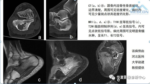 跟骨病变都在这里，赶快收藏吧！