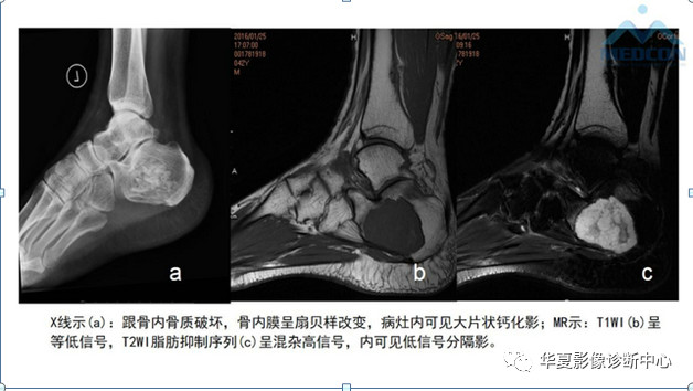 跟骨病变都在这里，赶快收藏吧！